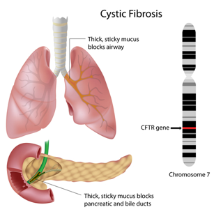 schematic of causes of CF
